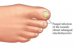 Fungal nail infections