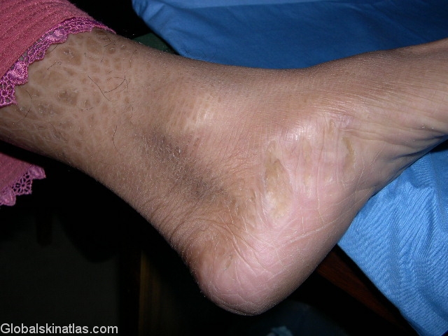 Ichthyosis vulgaris: Pictures, diagnosis, and treatment