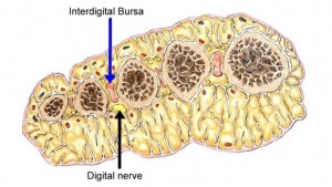 Inter-digital Bursitis