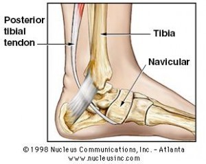 Posterior Tibialistendinopathy