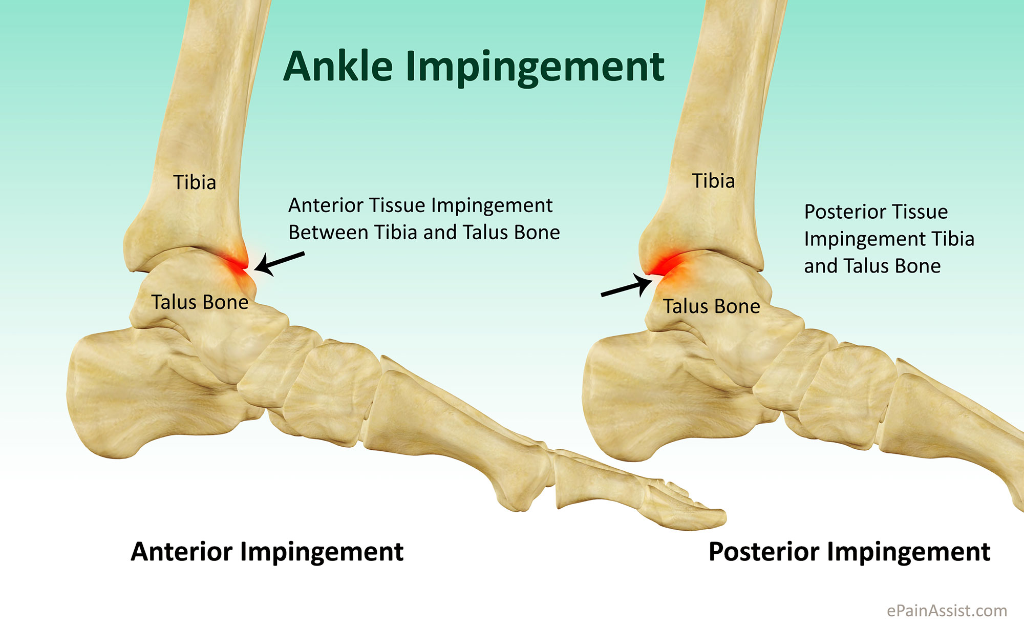 Anterior ankle impingement