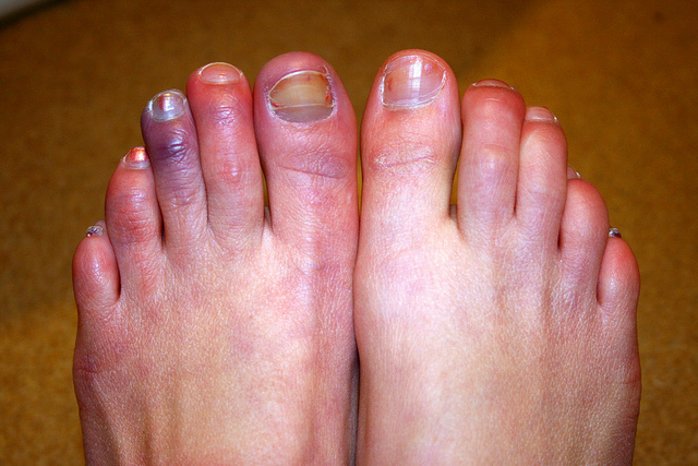 Causes For Itchy Swollen Toes