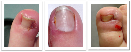 Ingrown Toe Nails, Inertia Health Group Adelaide