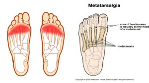 metatarsalgia