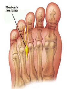 ball feet bone anatomy