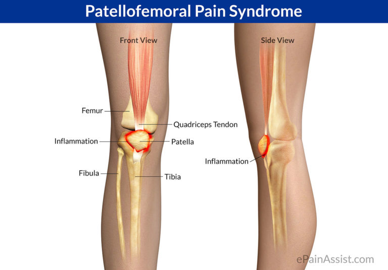 patellofemoral-pain-syndrome-podiatry-hq