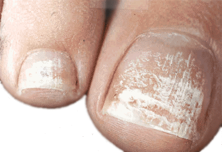 The Different Types of Fungal Nail Infection and How They Present