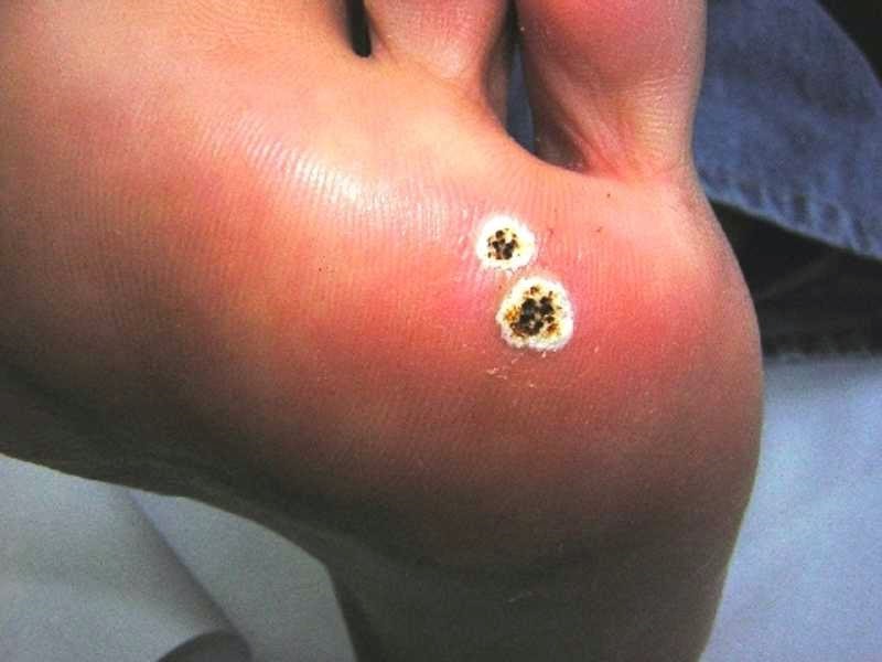Foot warts that won t go away, Wart on foot will not go away