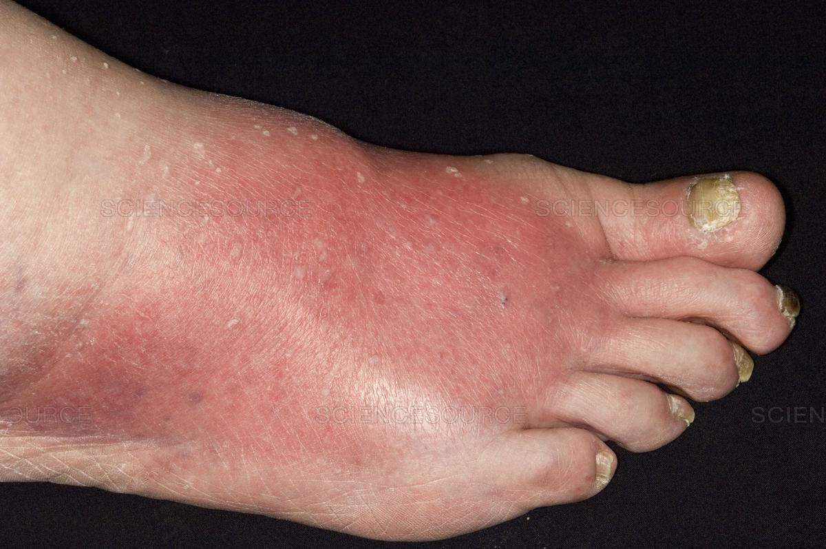 cellulitis toe