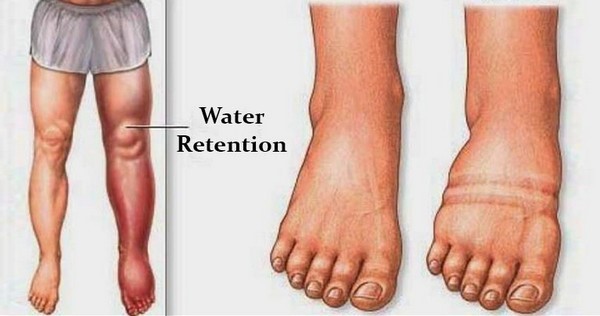 Are your ankles and feet swollen? Then you may have Ankle Oedema - Podiatry  HQ