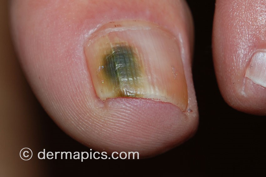 Redness of the nail bed caused by infection - wide 3