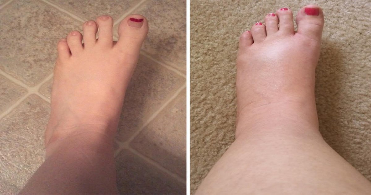 Why Do Feet Get Swollen After Giving Birth