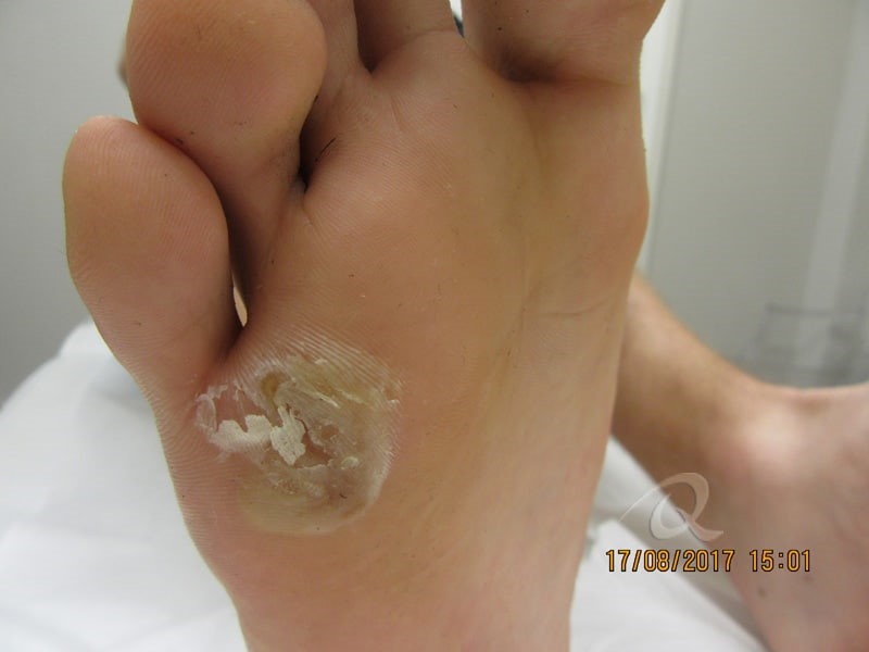 do warts on foot hurt)