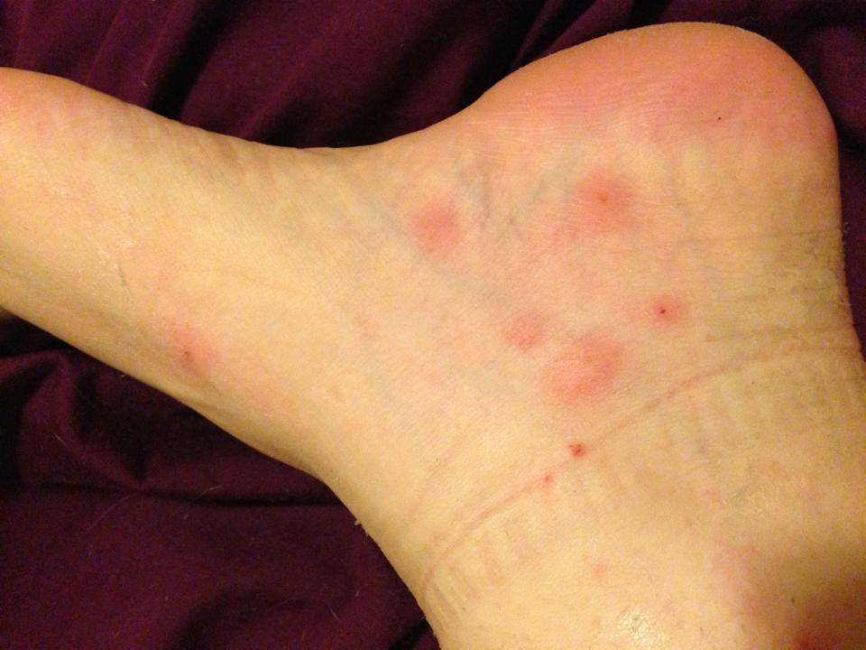 itchy-bumps-on-foot-and-ankle-discount-emergencydentistry