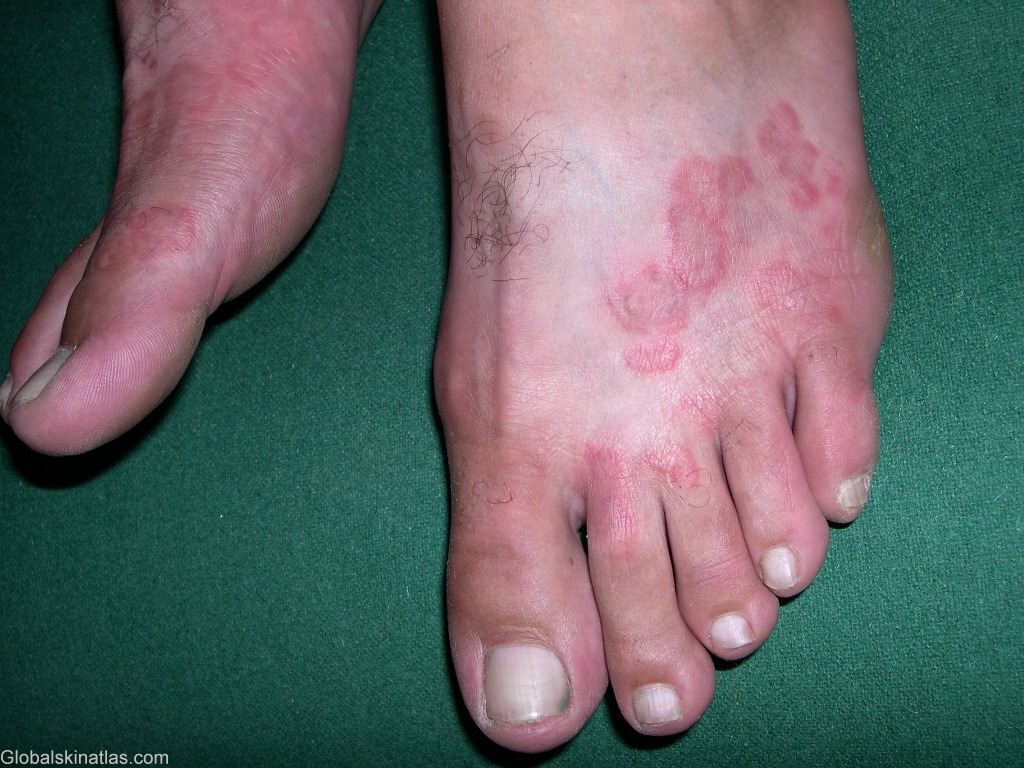 Fungal Rash On Skin 