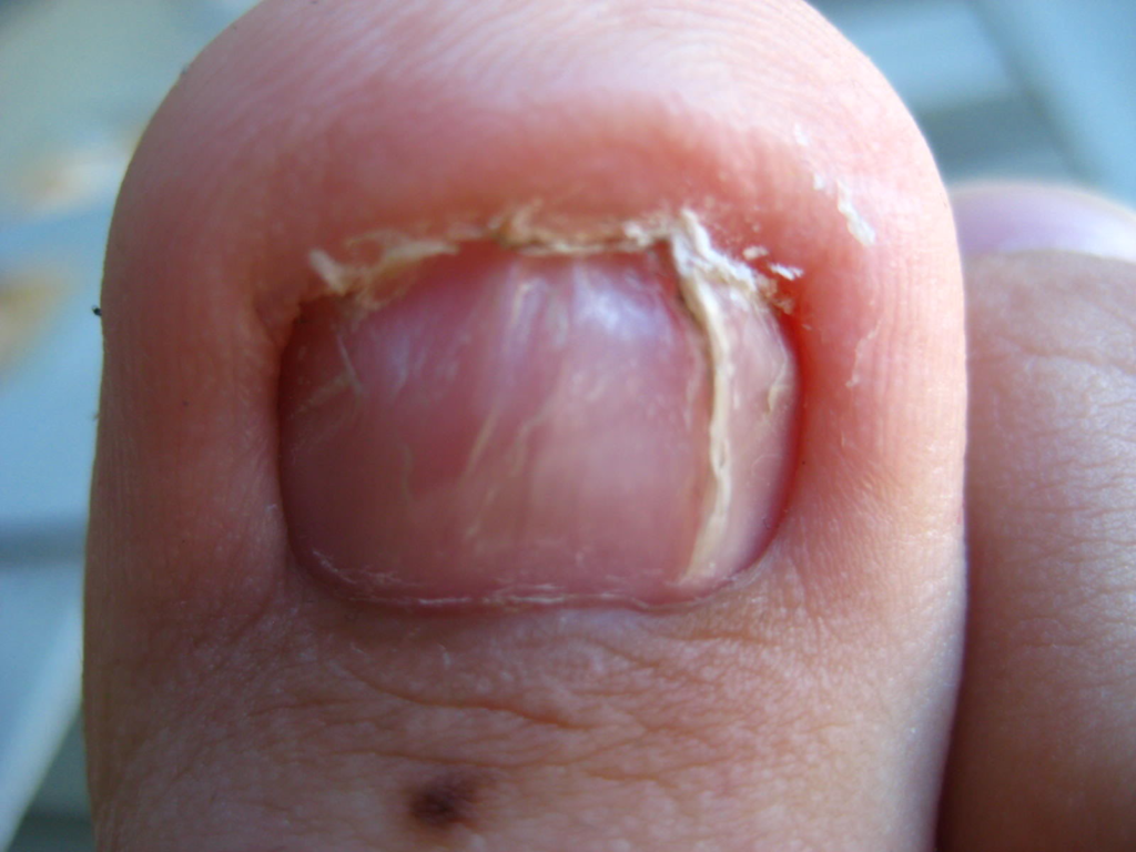 do-you-have-a-dead-toenail-podiatry-hq-clinics