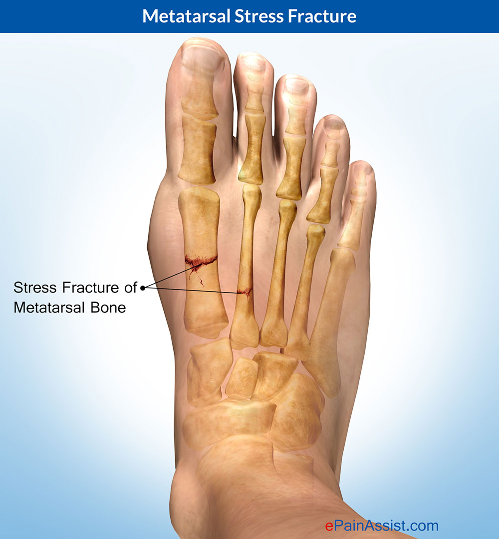 All About Foot Stress Fractures